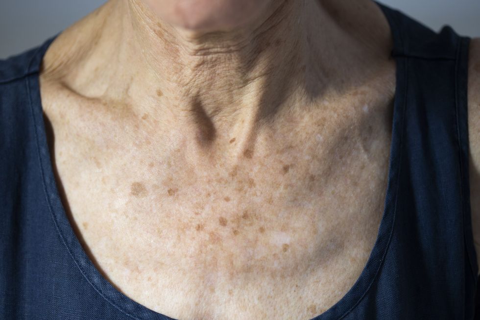 age spots
