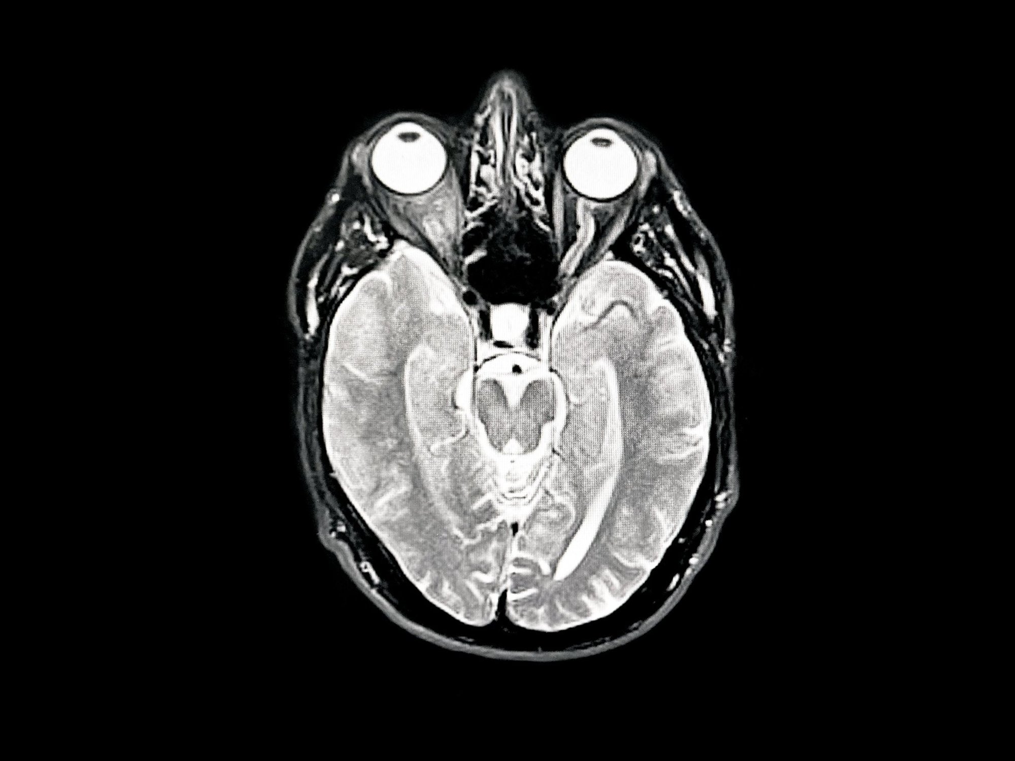 Alzheimer's disease