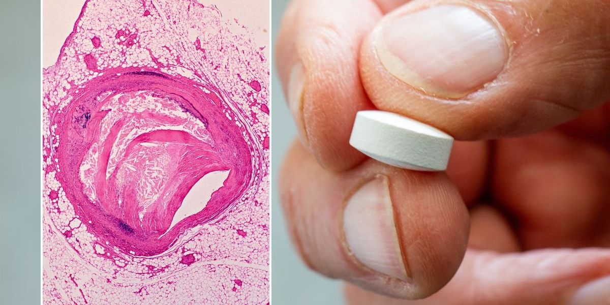 High cholesterol: Drug that slashes bad cholesterol levels by nearly 60% offers hope to statin-resistant patients