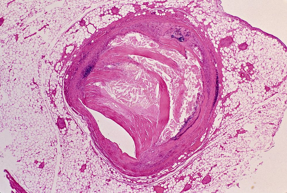CHOLESTEROL IN BLOOD