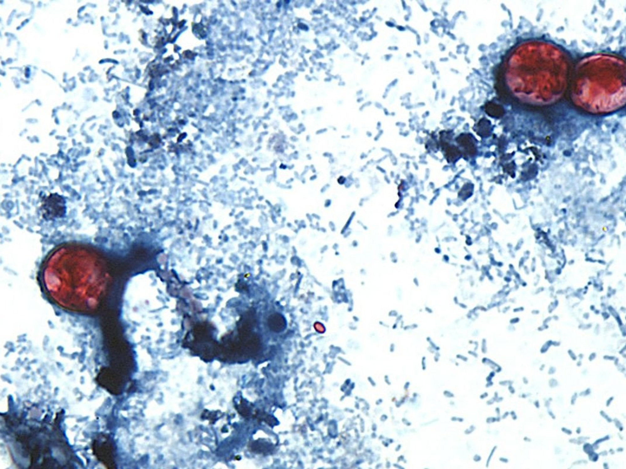 cyclosporiasis