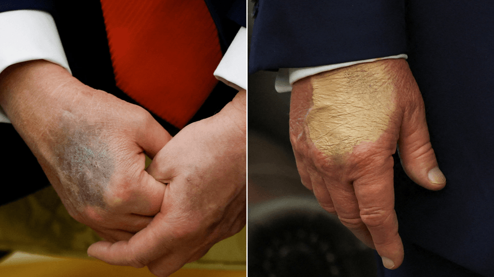 Donald Trump's hands