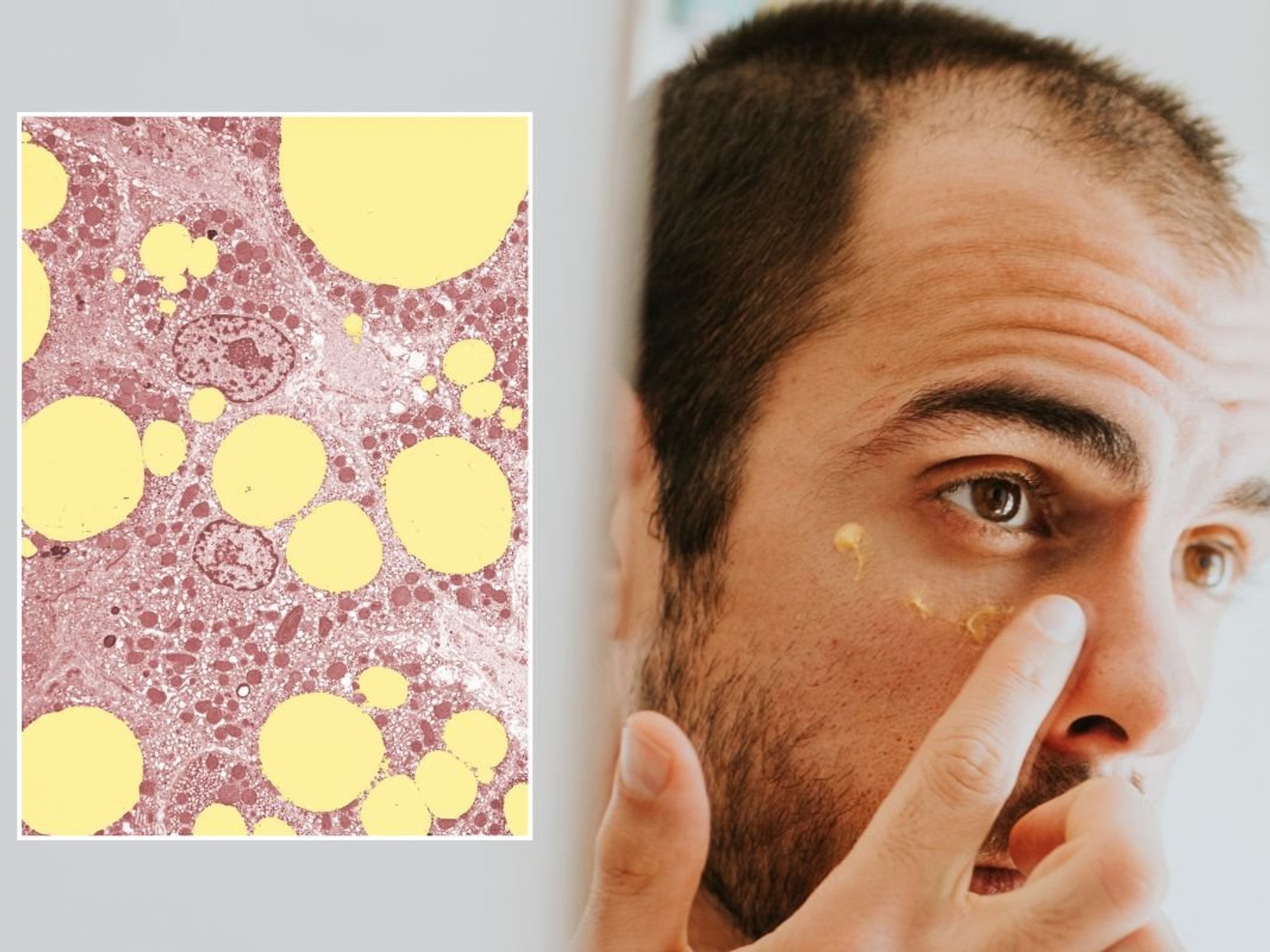 EYE INSPECTION FATTY LIVER CELLS