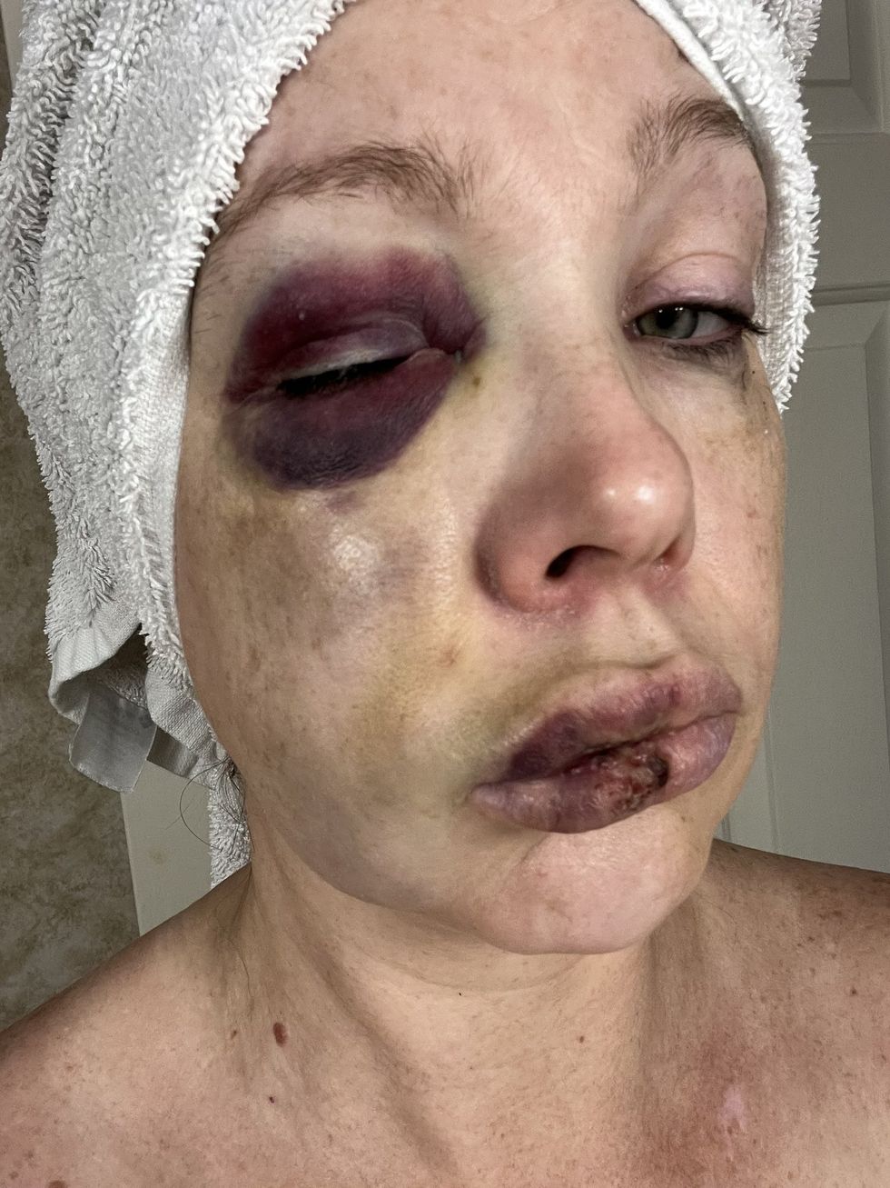 Holly injuries