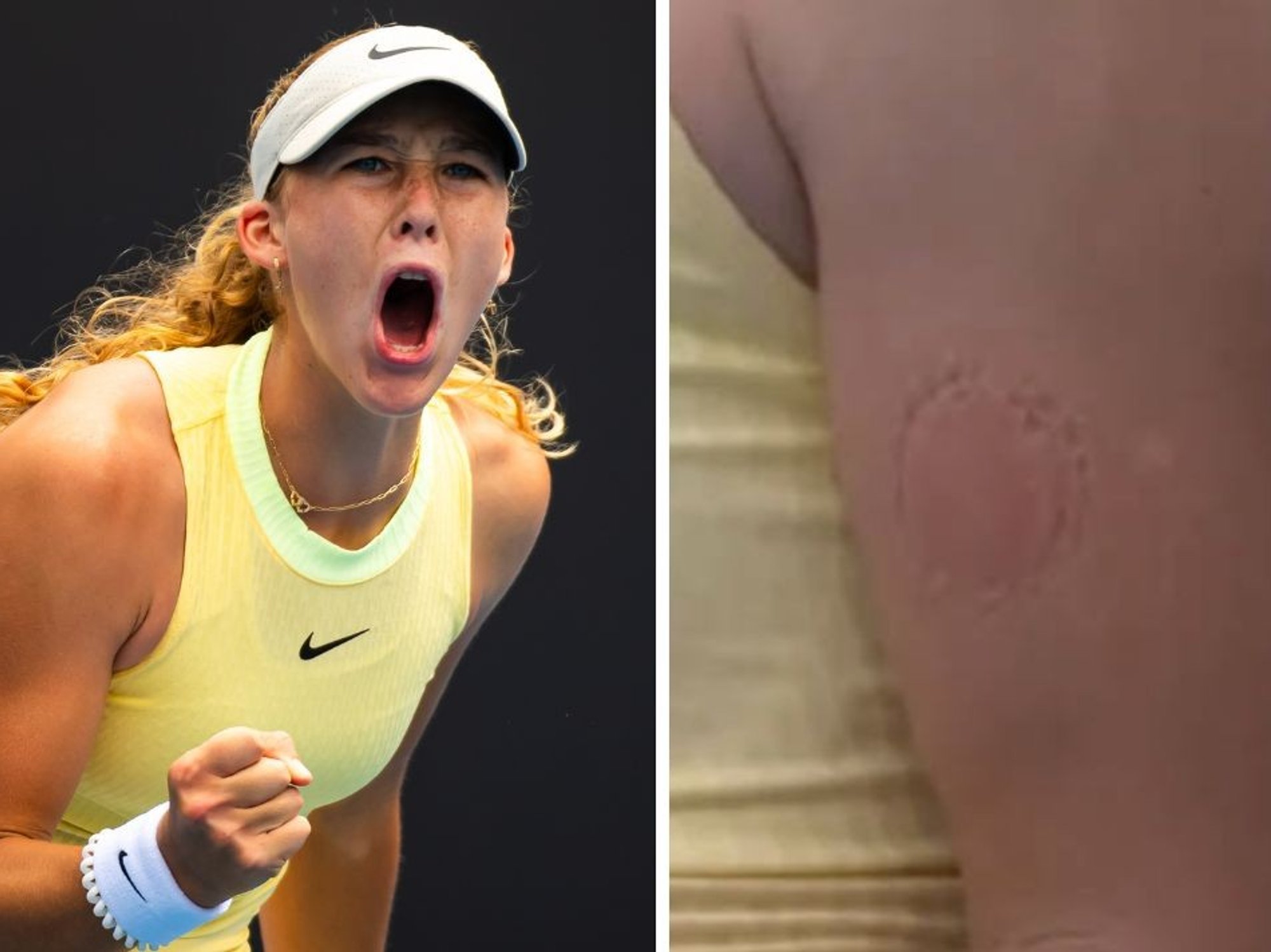 Australian Open star Mirra Andreeva shows off huge bite marks on her arm after angry outburst