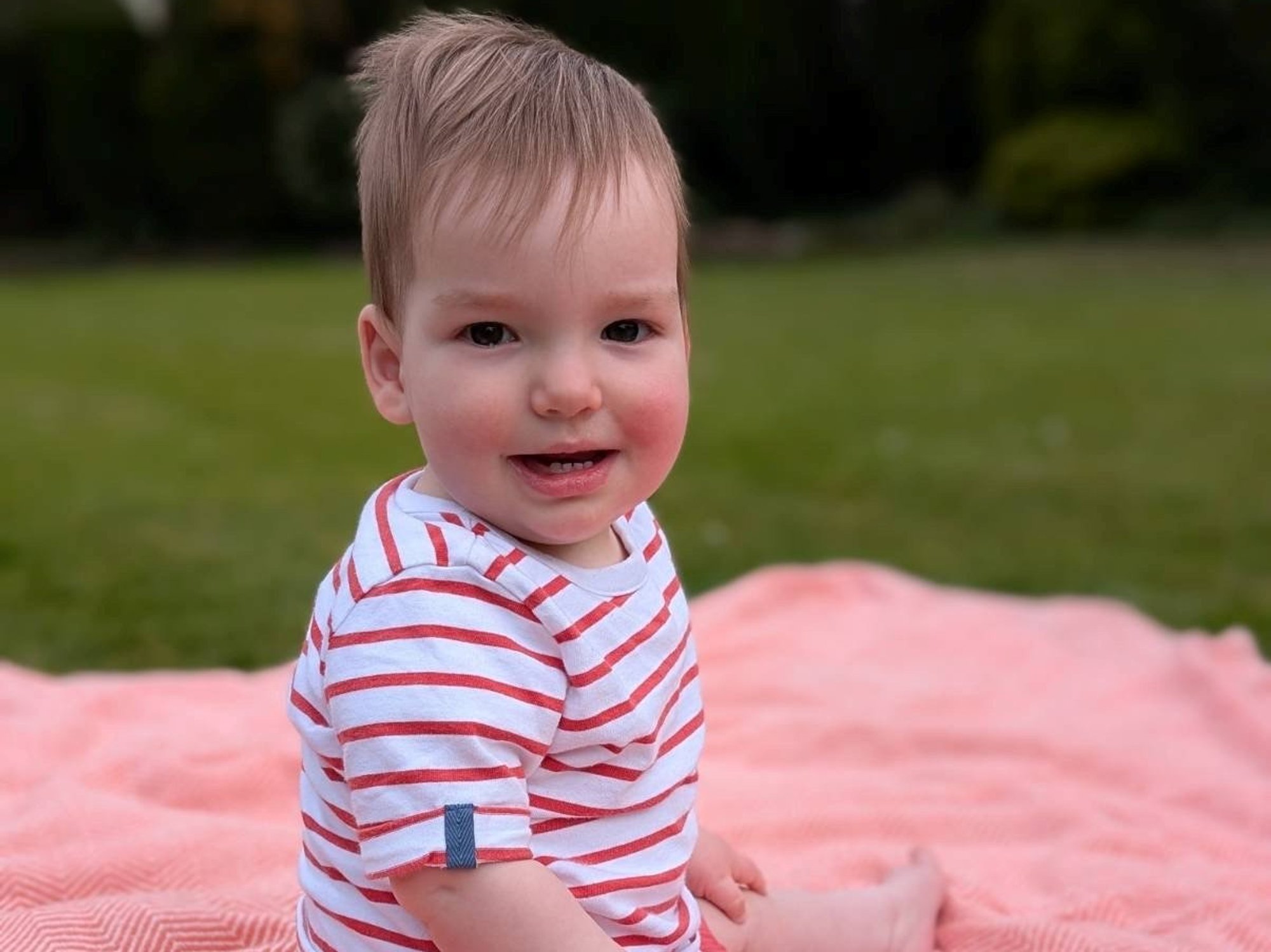'Cheeky' one-year-old baby boy with rare skull condition successfully undergoes world-first surgery