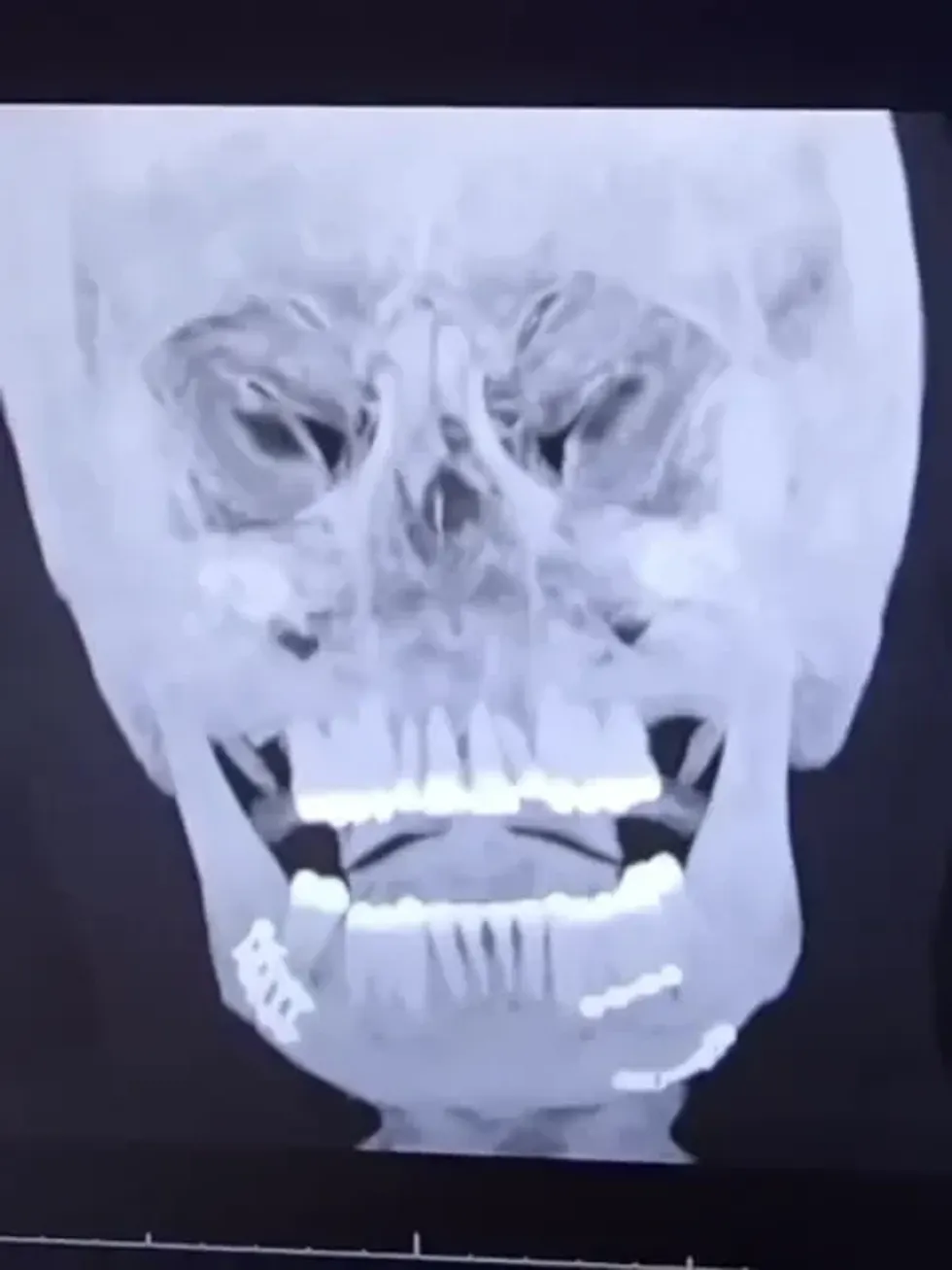 Jake Paul X-ray