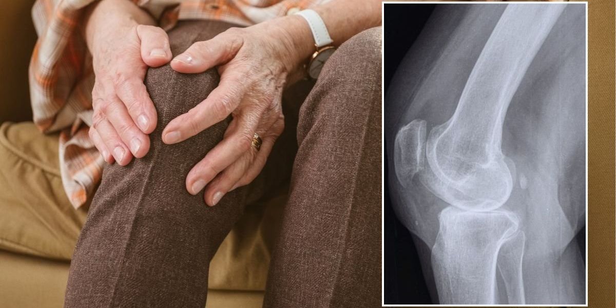 Osteoarthritis: Daily supplement shown to ease knee pain within six weeks