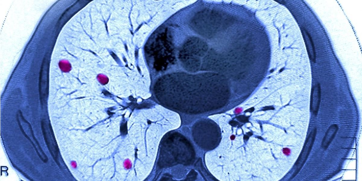Lung cancer breakthrough could cut treatment delays for thousands