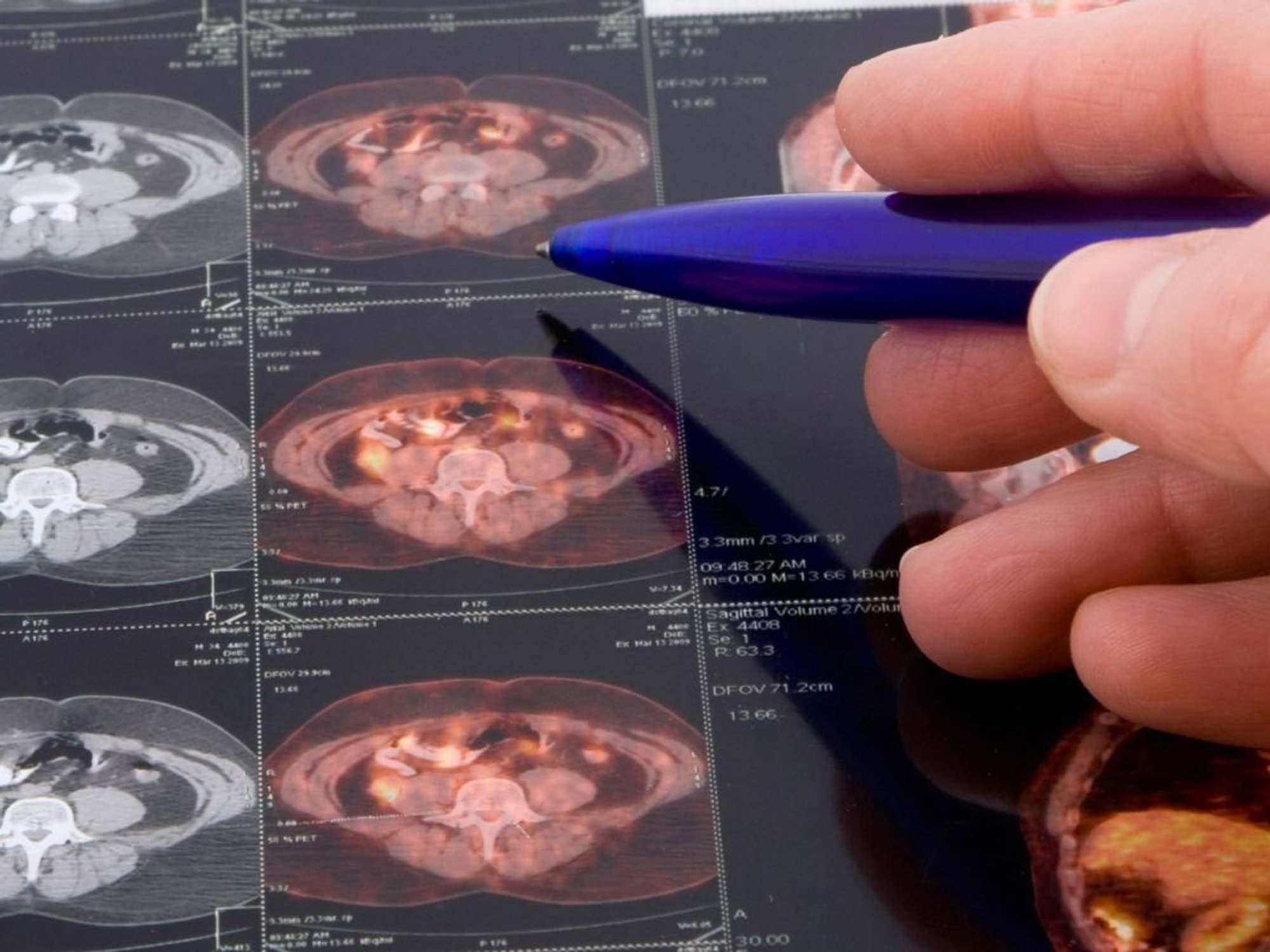 Prostate cancer scans