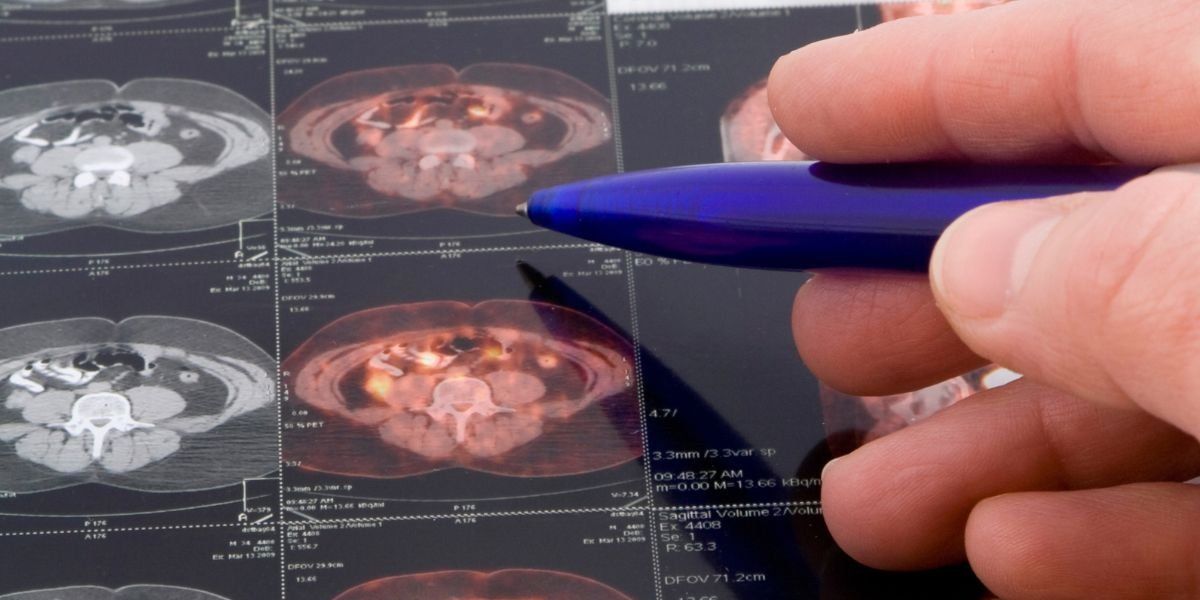 Prostate cancer warning as one diagnosis made every eight minutes