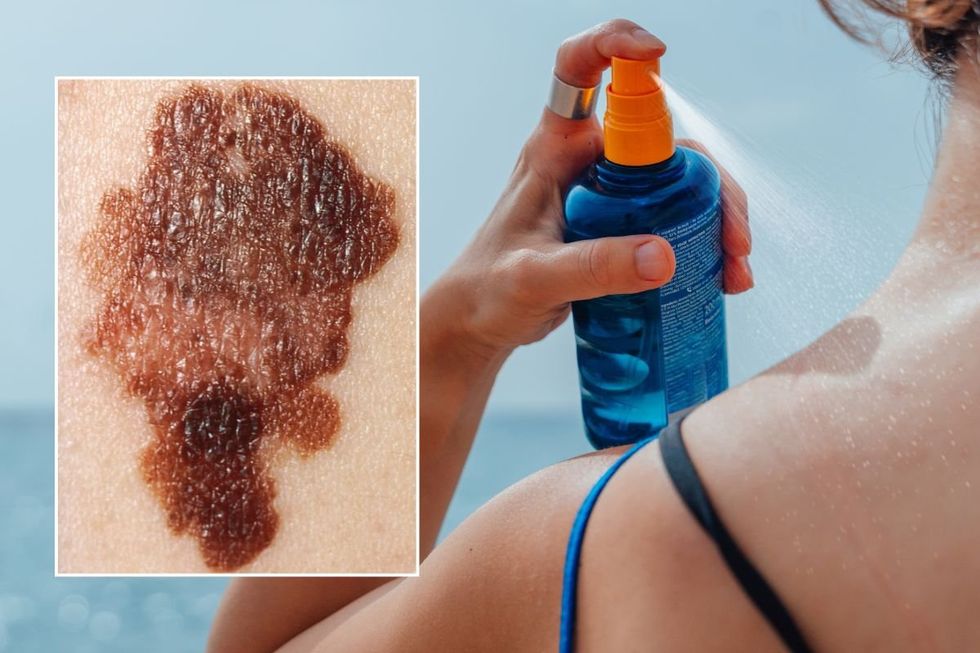 SKIN CANCER