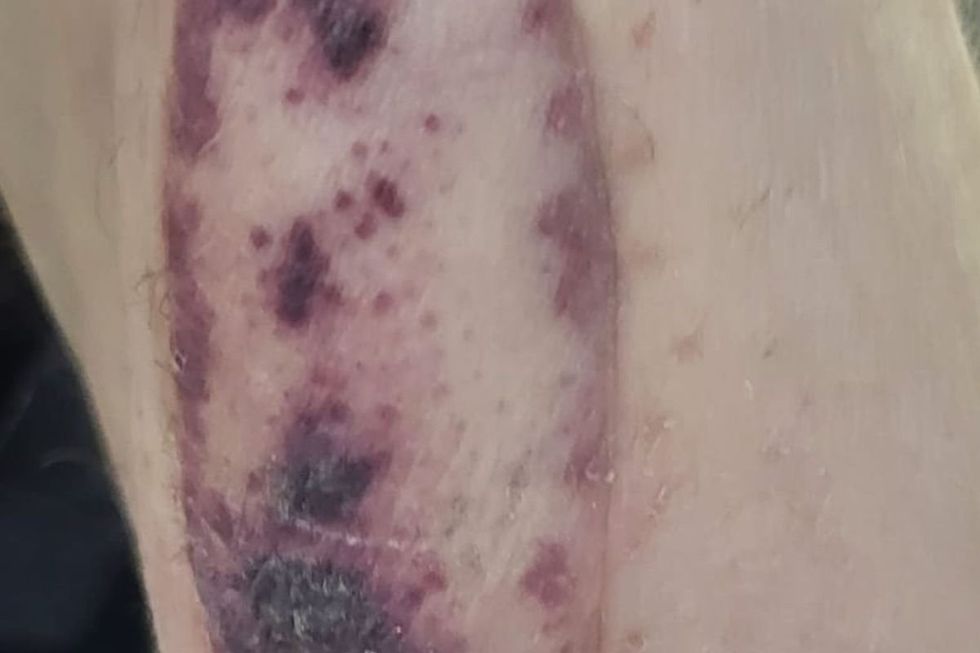 skin patch