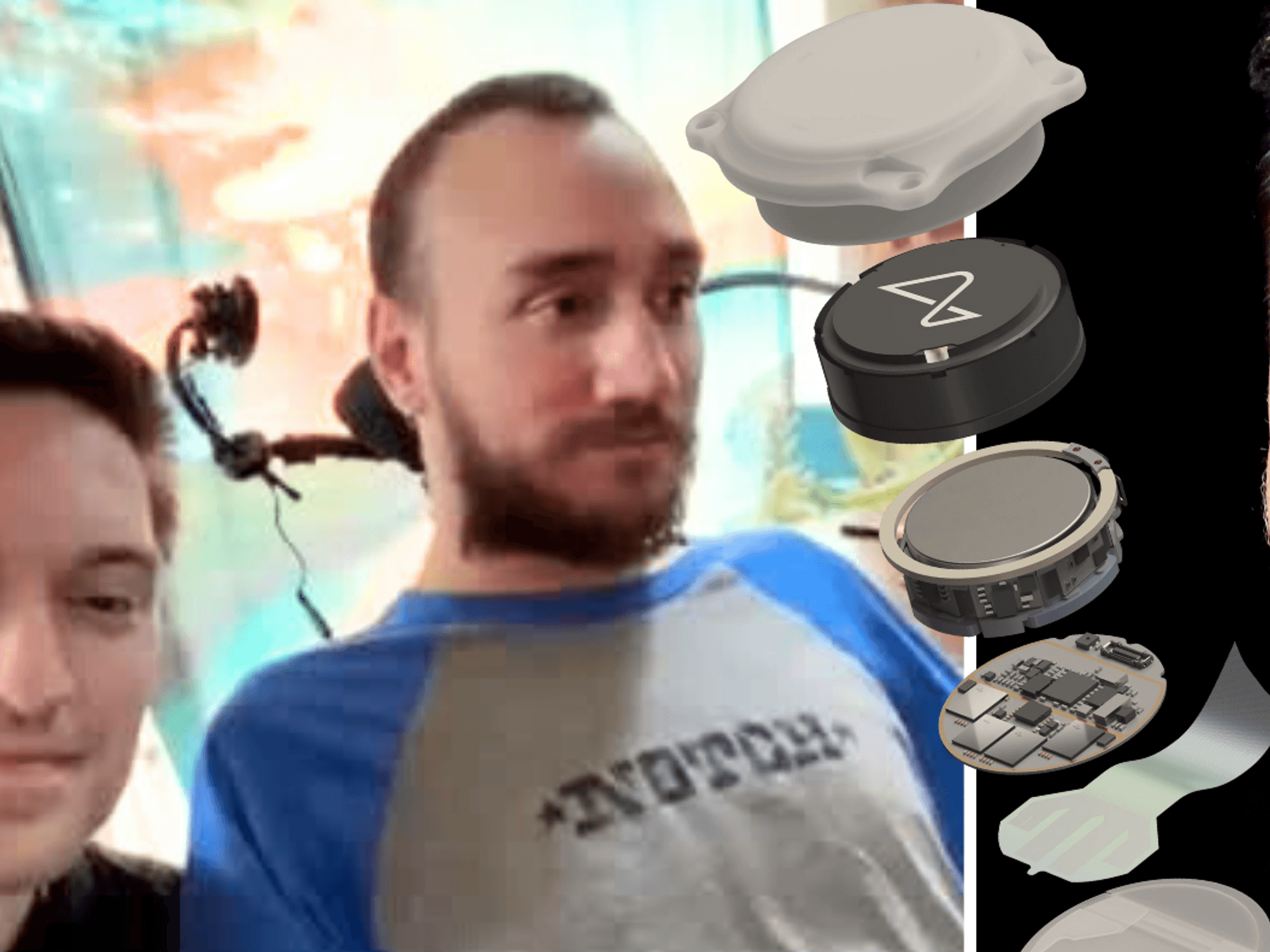 split image showing neuralink human patient noland arbaugh, the chipset that was implanted in his head, and billionaire entrepreneur elon musk