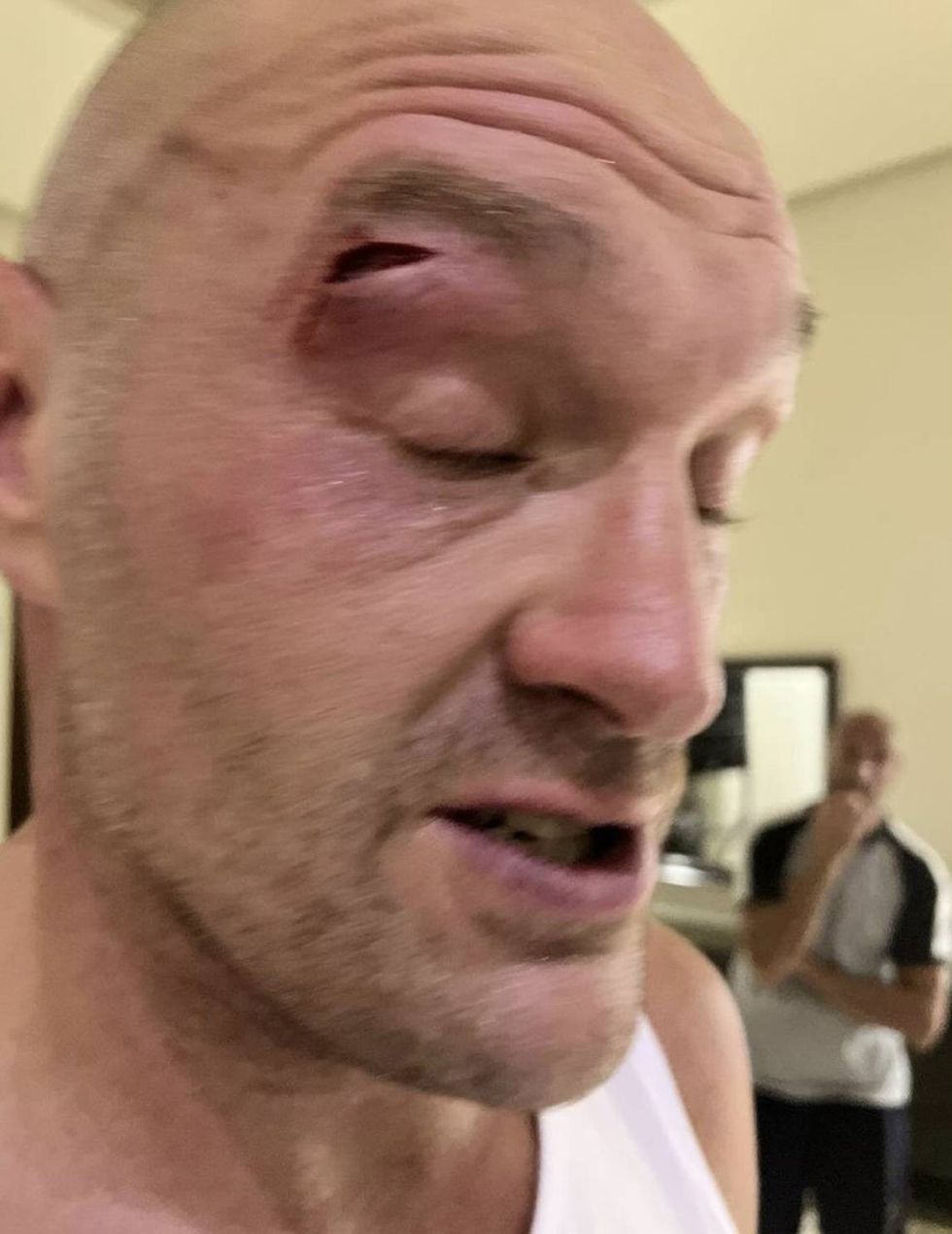 Tyson Fury has suffered a huge cut in training