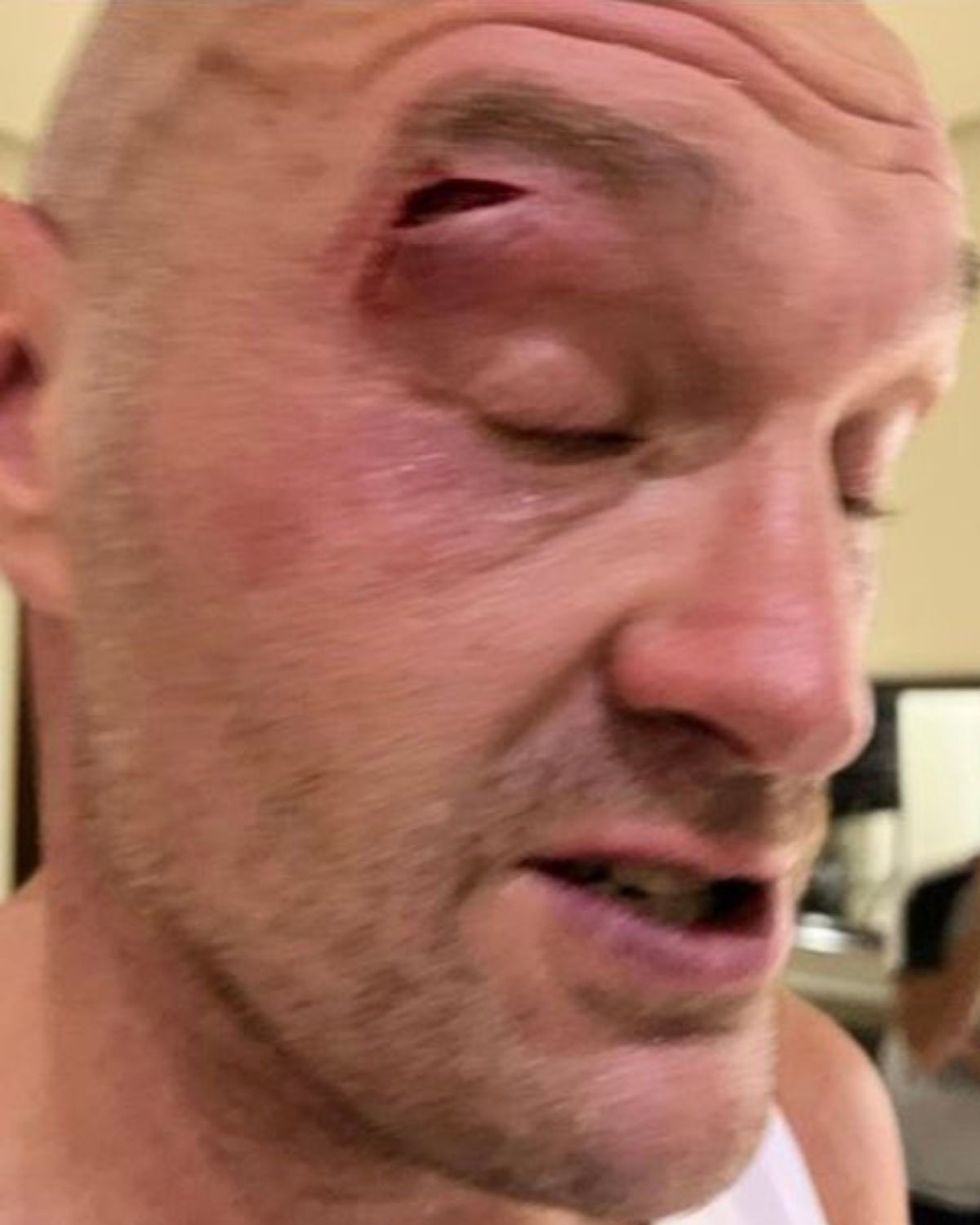 Tyson Fury