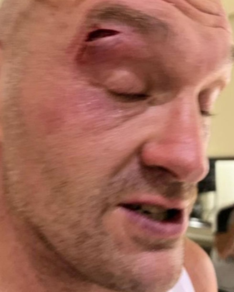 Tyson Fury