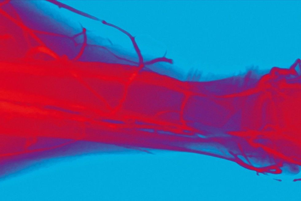 VEIN X RAY
