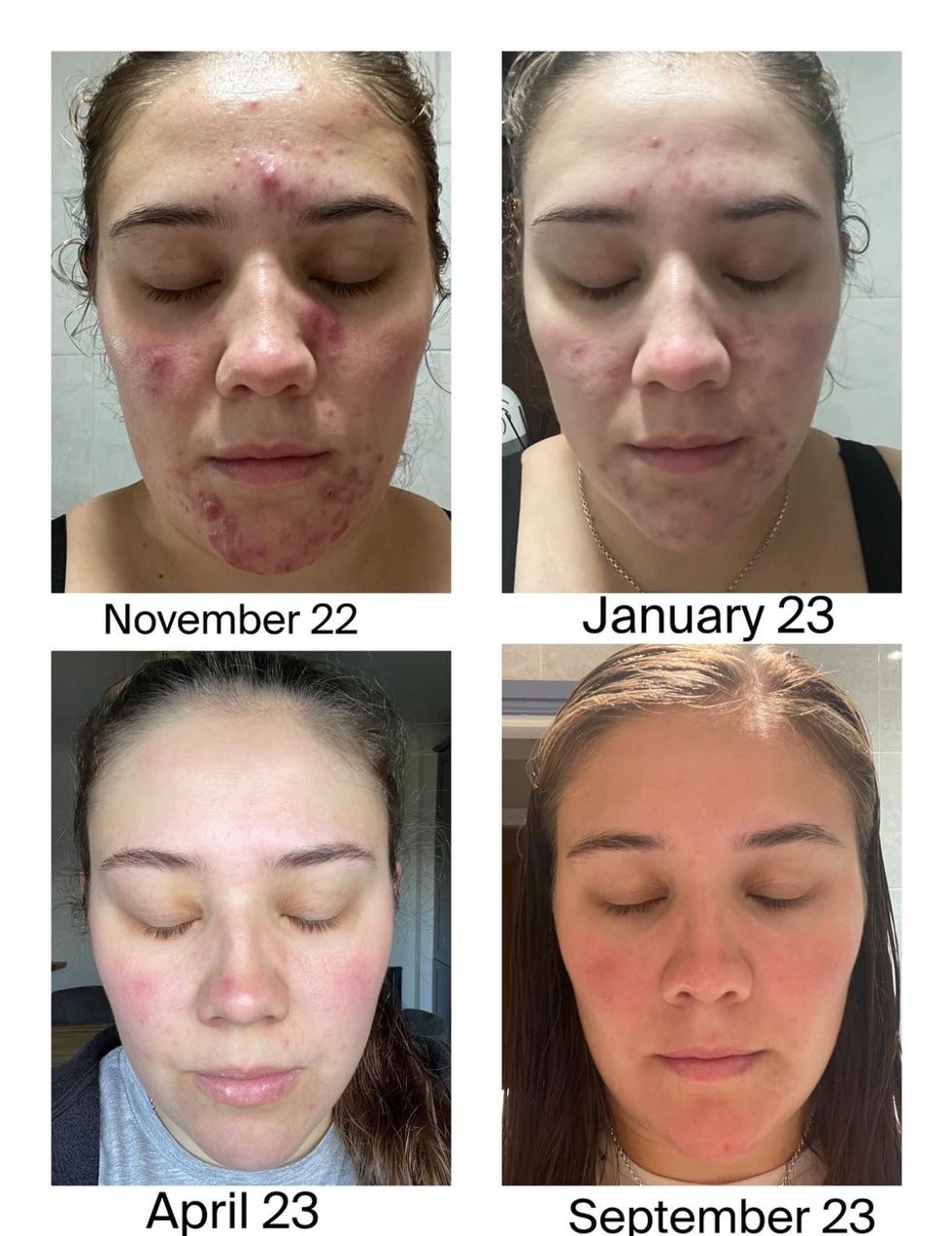 Woman before after skin transformation