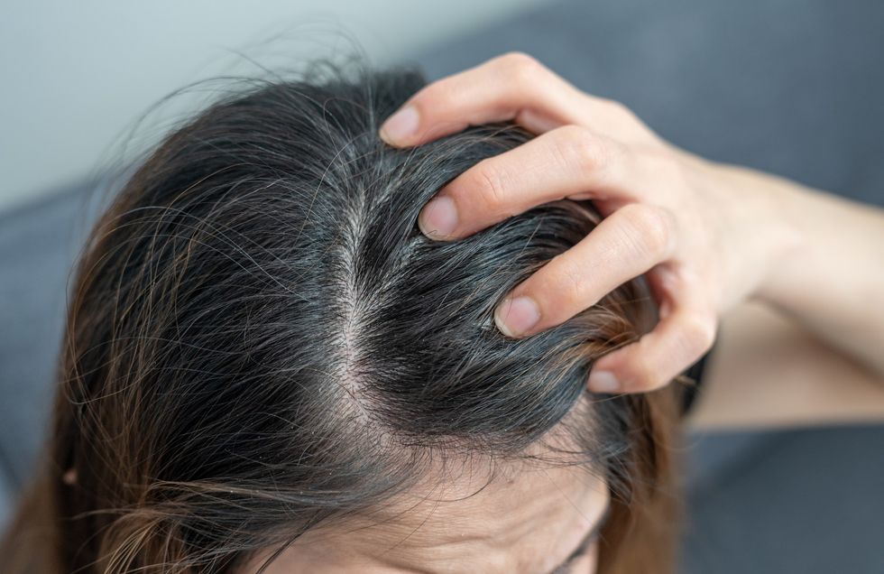 Woman with dandruff