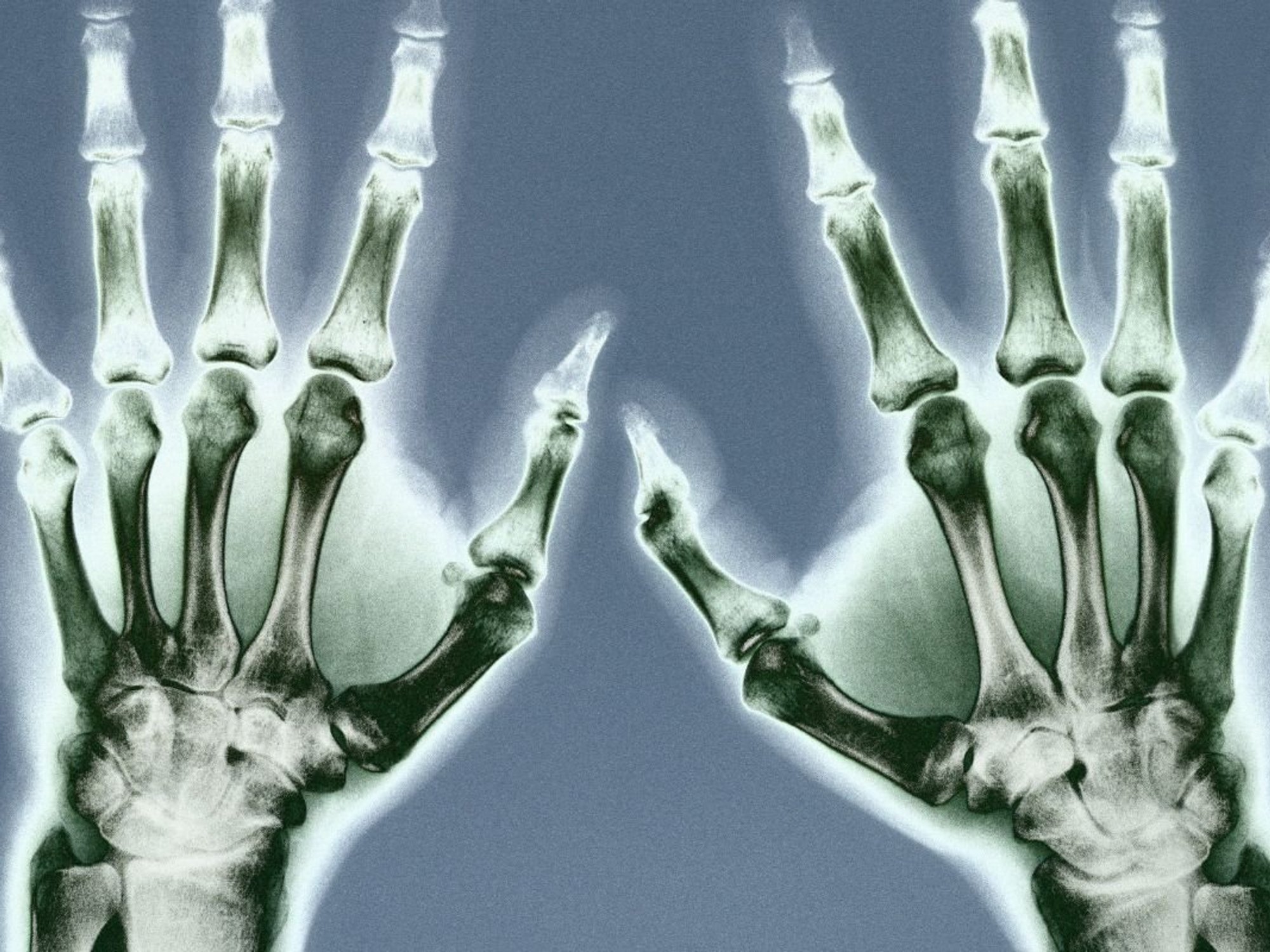 X-RAY OF HANDS